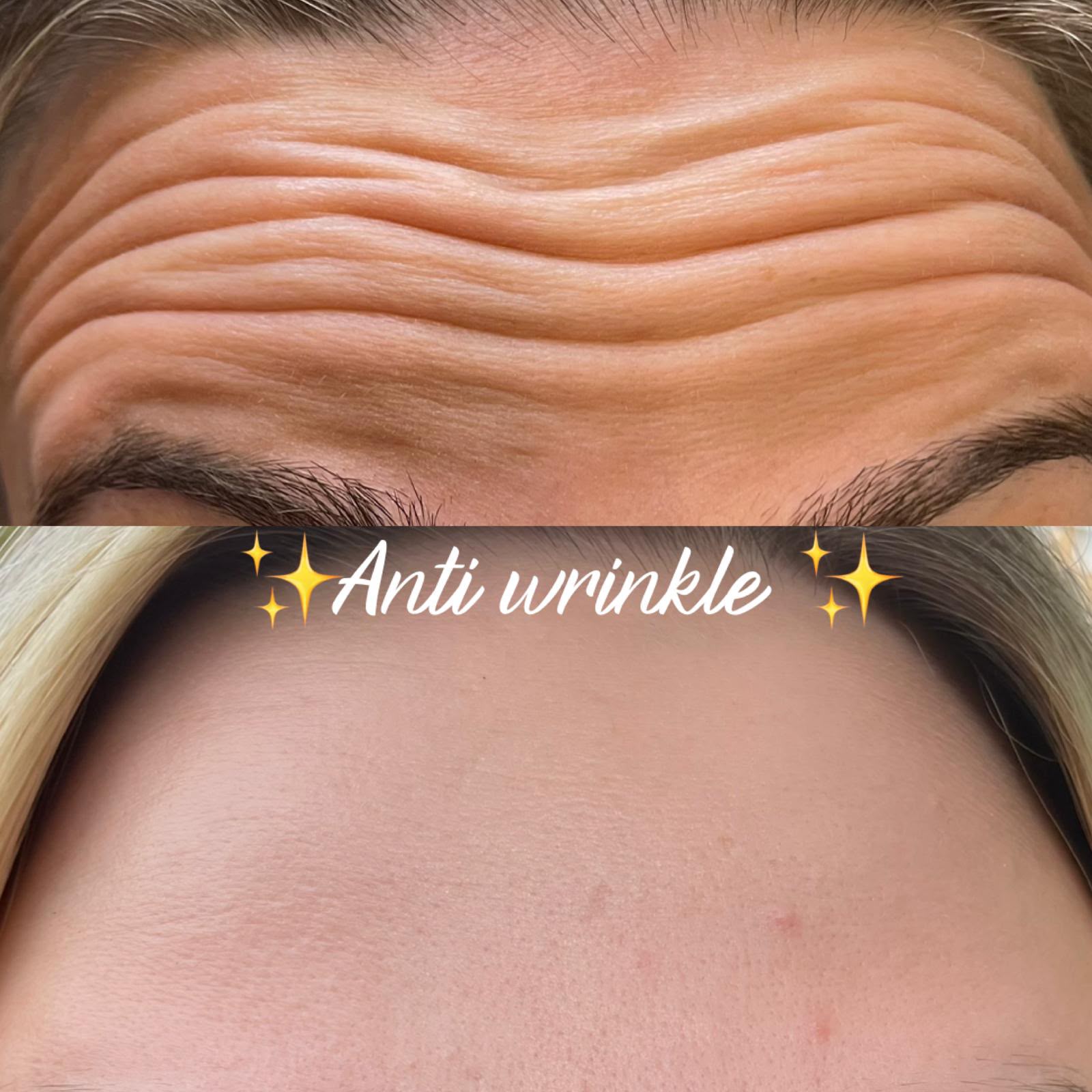 Anti-wrinkle forehead before and after