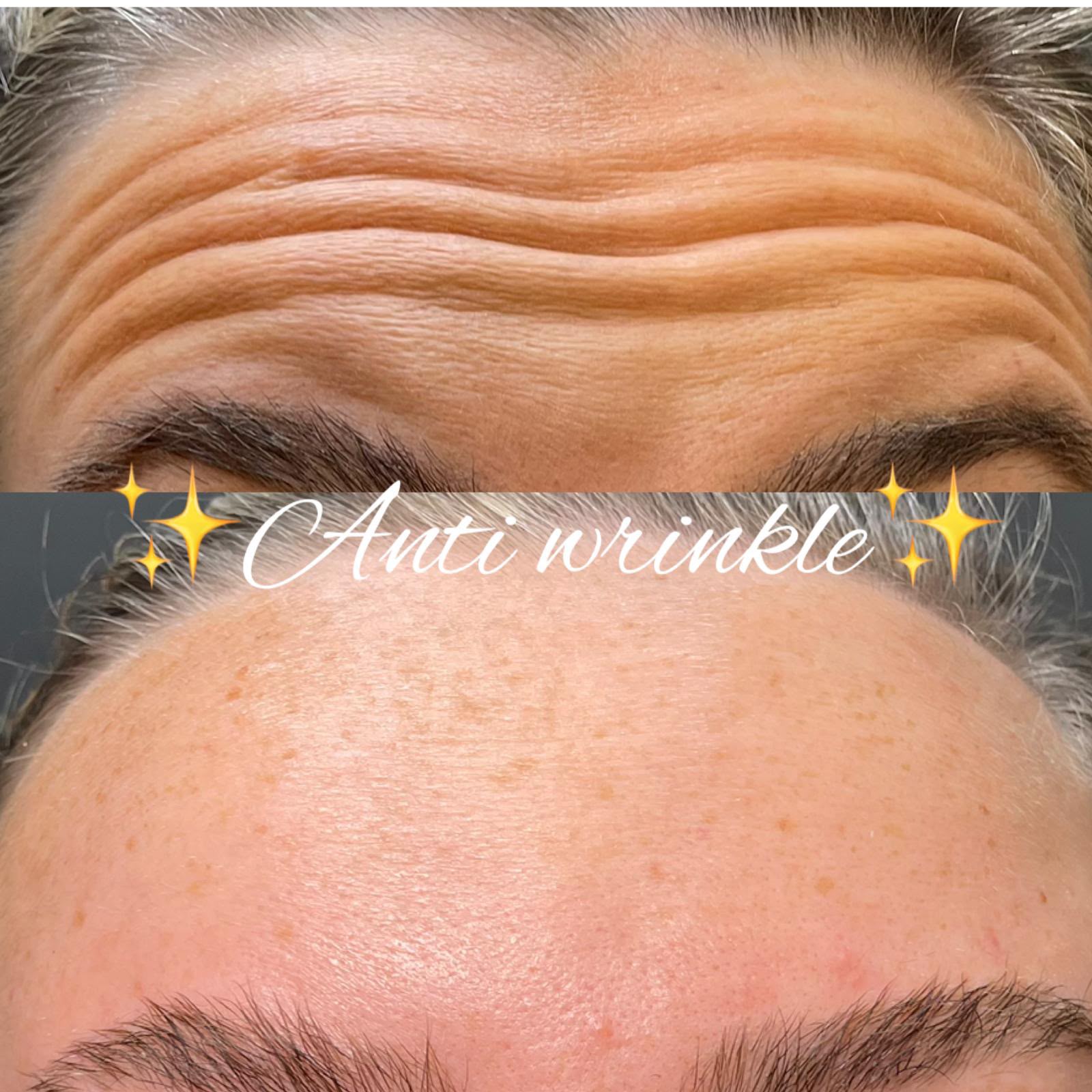 Anti-wrinkle treatment results