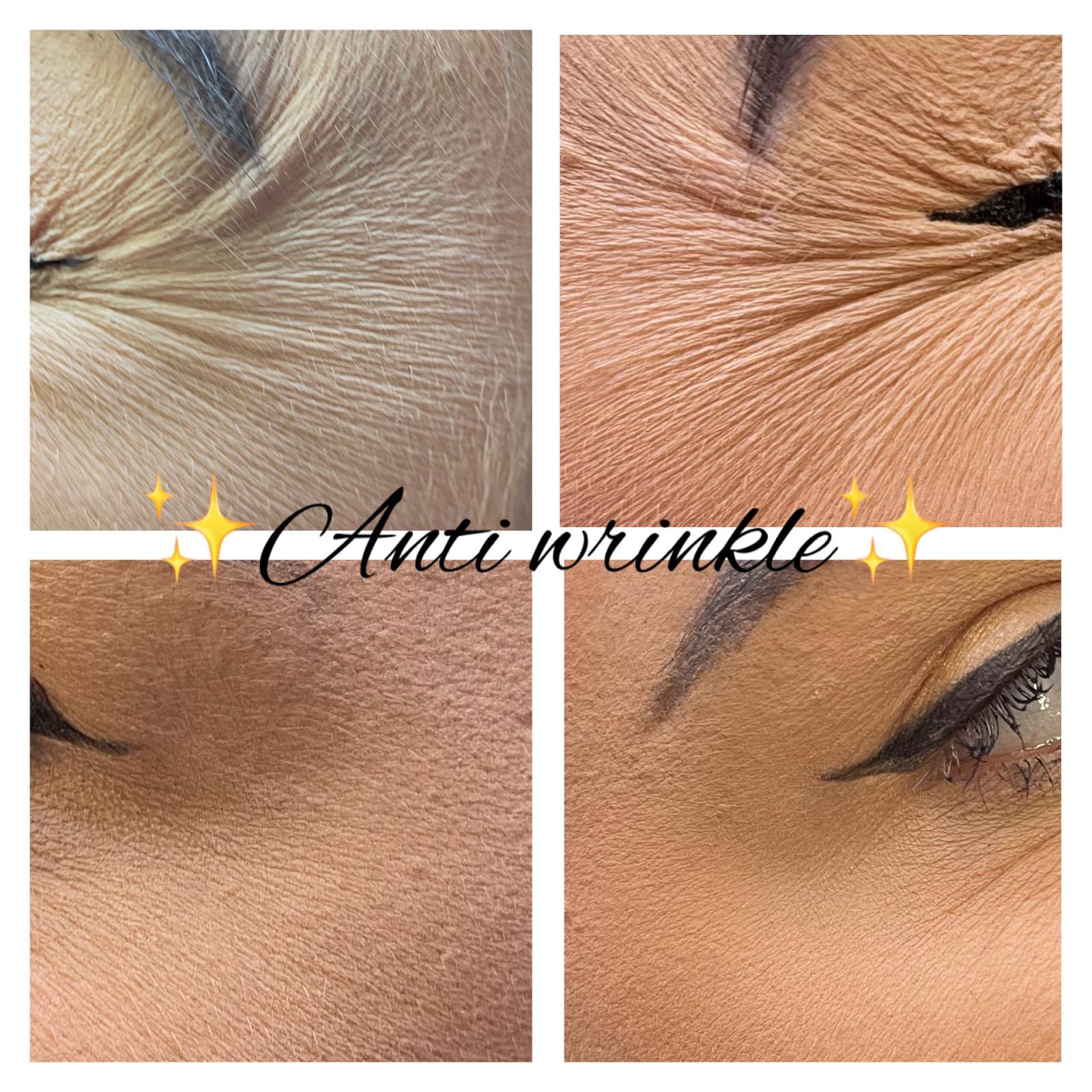 Anti-wrinkle eye and forehead collage